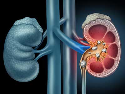 Best Ayurvedic Doctor for Kidney Stone in Moshi, Pimpri-Chinchwad